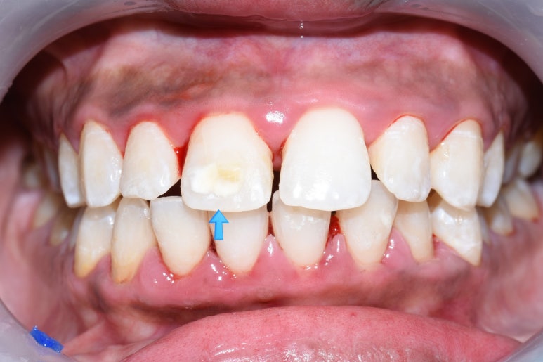 [서울역/충정로/치과] 화이트스팟+충치가 결합된 치아의 resin레진치료 케이스 관련 이미지 4