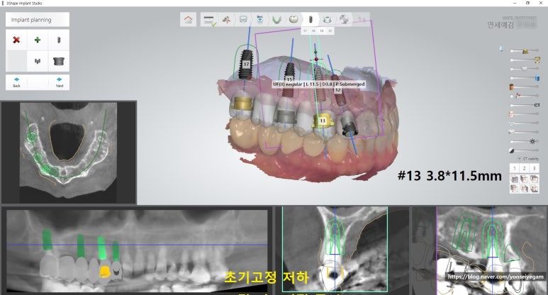 [시청역/서울역]네비게이션인플란트를 이용한 여러개 임플란트 과정 관련 이미지 3