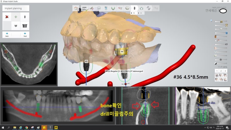[북창동 치과/연세예감치과]내비게이션임플란트소개 관련 이미지 25