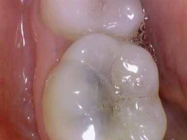 충정로 치과 인레이 해야한다고 들었는데 충치가 안보여요 관련 이미지 10