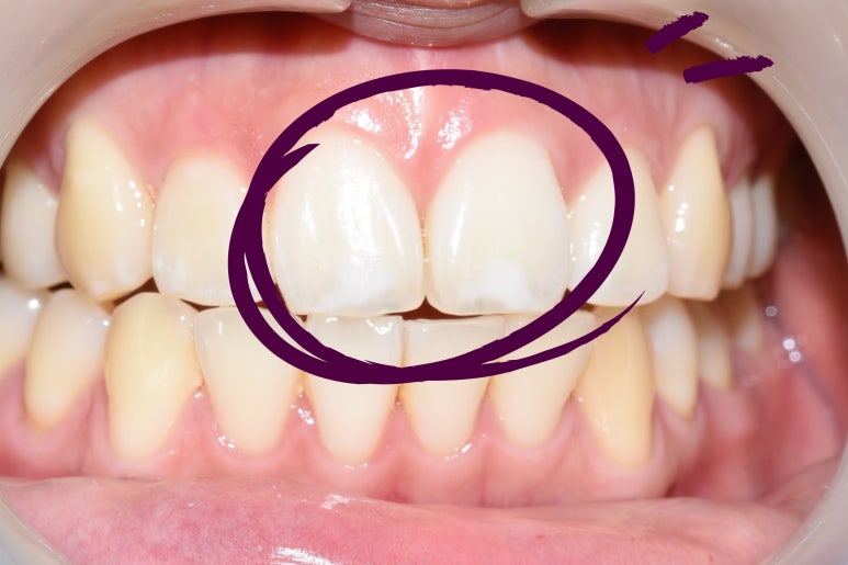 [시청역/치과] 화이트스팟, 반점치 앞니 치료 케이스 관련 이미지 1