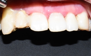 시청역치과 벌어진 앞니를 바르고 이쁘게! 대한심미학회회원치과 관련 이미지 7