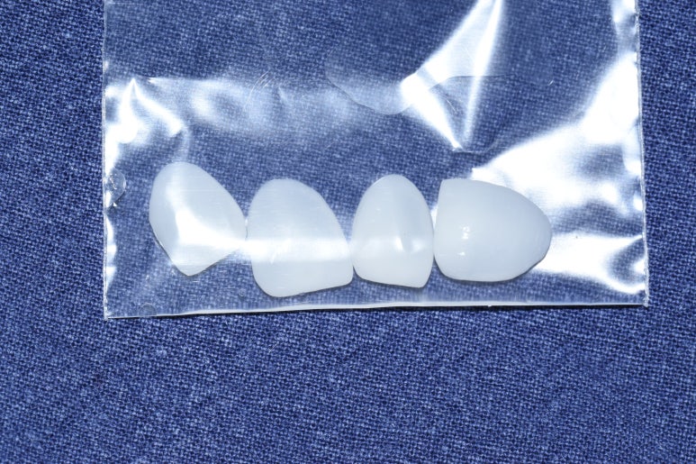 [서울역/을지로/치과] 본인이 옥니라고 생각한다면? 무삭제 라미네이트 어떤가요? 케이스 및 가격비용 관련 이미지 5