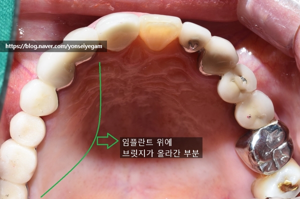 [시청역/서울역]네비게이션인플란트를 이용한 여러개 임플란트 과정 관련 이미지 11