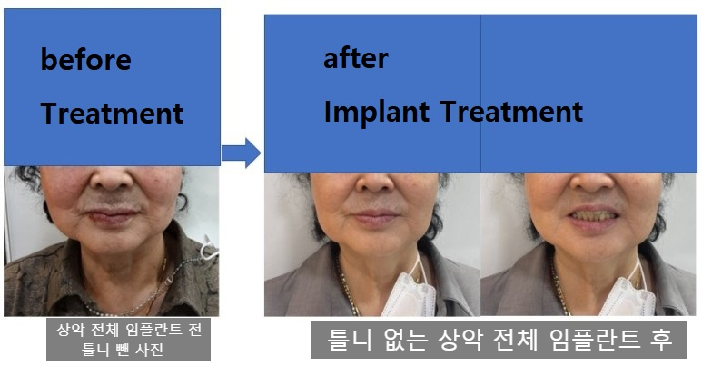 만65세이상 중 의료급여1종 보험임플란트 얼마일까요? 비용안내, 조건안내 관련 이미지 2