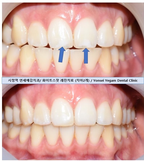 [서울 광화문/남대문] 화이트스팟 레진으로 치료케이스, 비용안내 등등 / 반점치, 반상치 관련 이미지 6