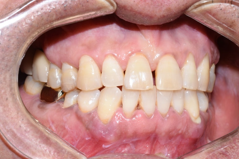 [서울시청역/남대문]어금니임플란트+상악동거상술(뼈이식):실제케이스 관련 이미지 9