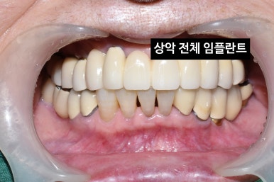 서울 중구 치과/이가 하나도 없는 환자의 치료방법/틀니, 풀아치임플란트, 전체 임플란트 등 관련 이미지 10