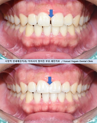 앞니사이벌어짐, 레진으로 메울 수 있을까? 비용,가격까지. 종로치과/광화문 치과 관련 이미지 5