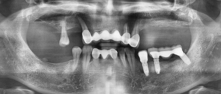 [임플란트/서울역] 서울 상악 전체인플란트 실제사례.극한의 케이스도 관련 이미지 1
