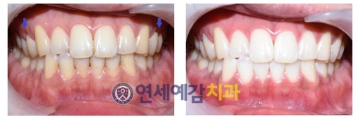 시청역/광화문/서울역 보험 스케일링안내(+치아미백이벤트안내) 관련 이미지 4