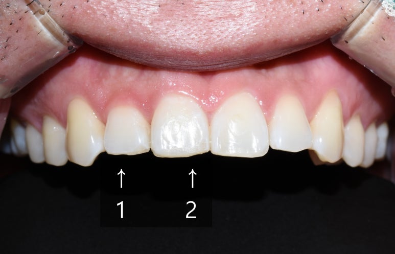 [서울역/치과] 앞니가 조금 아주조금 깨졌어요 치료가능한가요? 관련 이미지 6