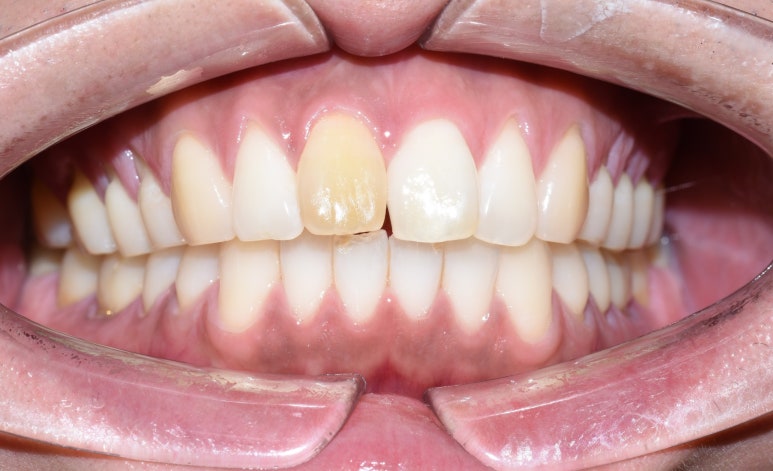 [종로/치과] 심한 변색치아&튀어나온 치아 1개 크라운 케이스 관련 이미지 1