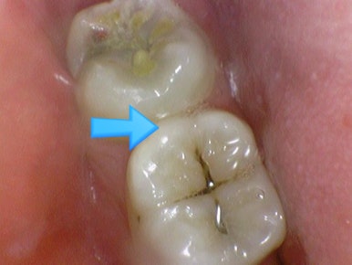 [서울시청역] 눈에 보이지 않는 충치 실제사진 관련 이미지 6