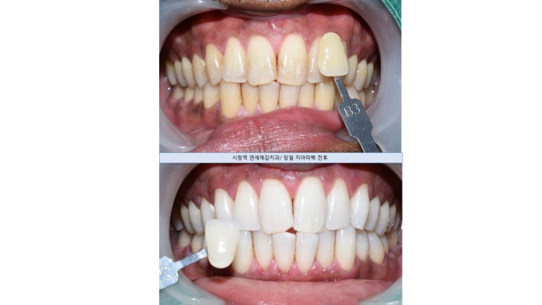 [해외에서도 찾아오는 서울시청역/치과미백]커피를 많이 마셔서 치아가 착색이 됐어요. 치아미백?? 관련 이미지 4