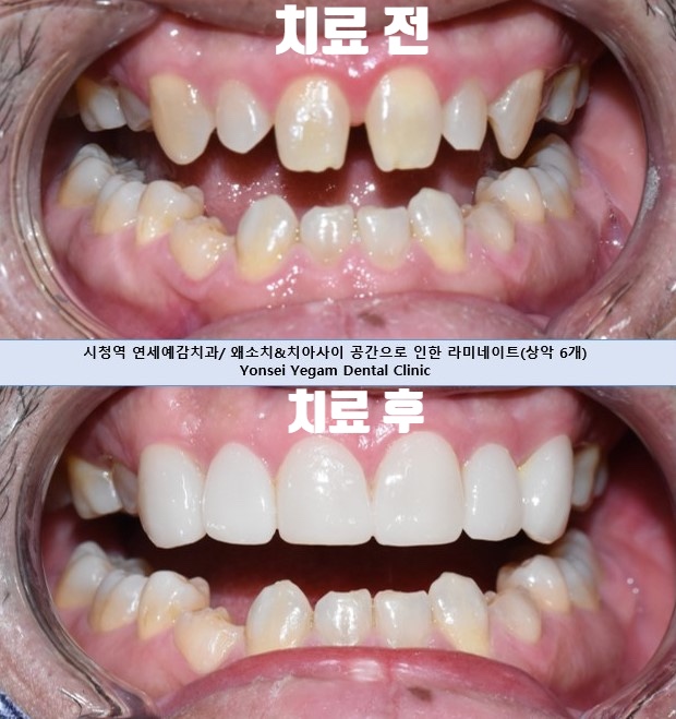 치아를 하얗게 하고 싶은 캐나다에서 오신 환자분의 라미네이트 사진공개이벤트진행중 관련 이미지 8