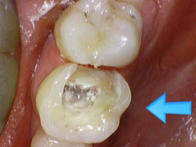 신경치료 끝났는데 크라운 해야하나요? 자연스러운 지르코니아 크라운 유명한 치과 가격까지 관련 이미지 7