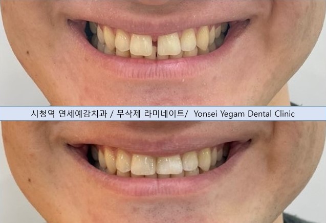 서울시청역치과/ 벌어진 앞니 치아 치료/ 왜소치, 다이아스테마 등/레진, 라미네이트, 부분교정 비교 관련 이미지 23