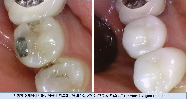 [시청역치과] 미국에서도 크라운 하러 일부러 찾아오는 치과 인증사진 관련 이미지 7
