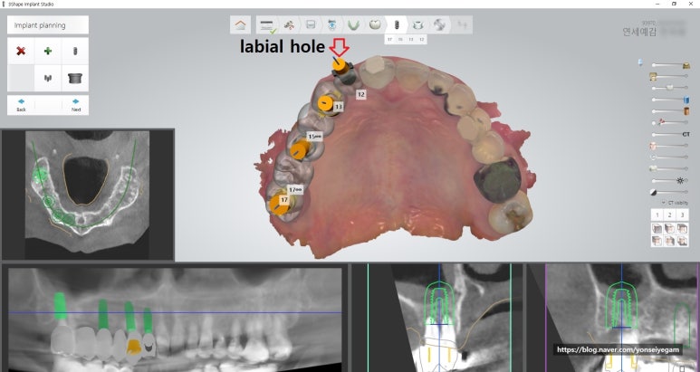[시청역/서울역]네비게이션인플란트를 이용한 여러개 임플란트 과정 관련 이미지 6