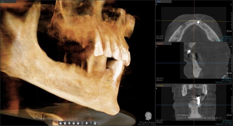 임플란트, 빼면서 바로 심을 수 있나요? (발치즉시 임플란트) 관련 이미지 3