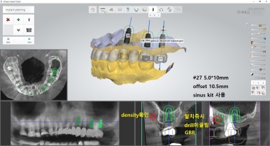 앞니 여러개 임플란트 잘하는 치과 서울역치과 실제사진 관련 이미지 11