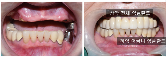 만65세이상 중 의료급여1종 보험임플란트 얼마일까요? 비용안내, 조건안내 관련 이미지 1
