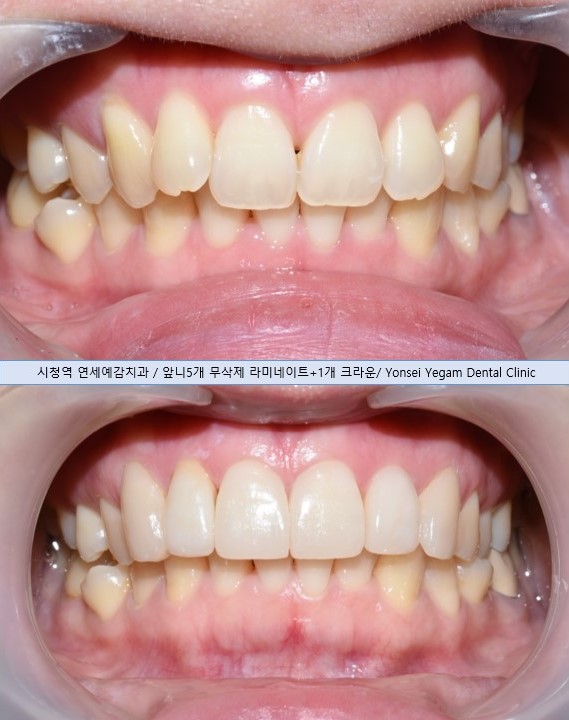 [시청역] 마스크를 벗을 그때를 대비한 이벤트! 치아미백/보톡스/라미네이트/앞니부분교정 이벤트가 안내 관련 이미지 4