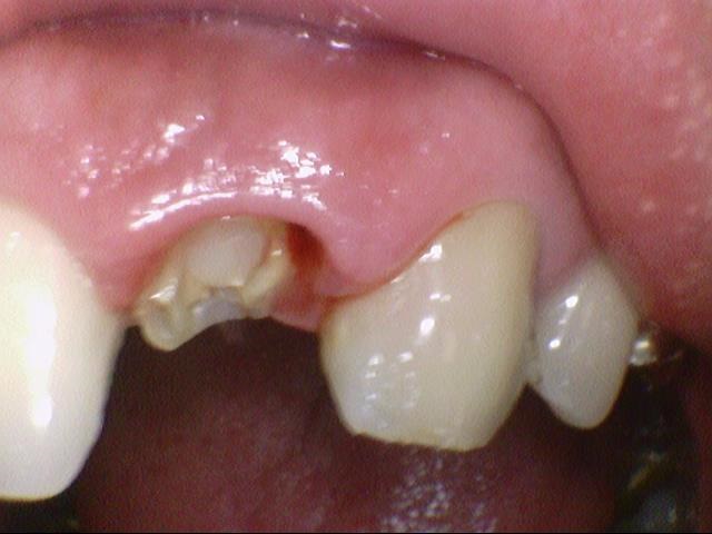 [시청역/서울역 치과] 앞니 치아부러짐 자연스럽게 치료사례 관련 이미지 11