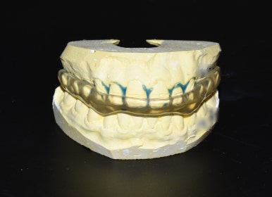 [시청역,서울역/치과] 개개인 맞춤형 치과제작 이갈이 장치로 이를 보호하세요& 비용,가격 정보 관련 이미지 2