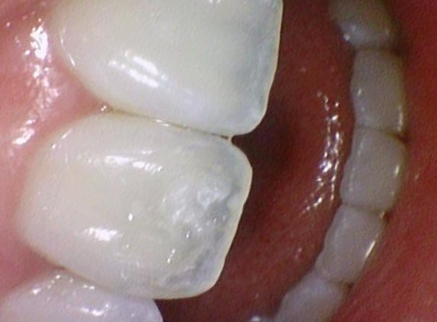 [서울 광화문/남대문] 화이트스팟 레진으로 치료케이스, 비용안내 등등 / 반점치, 반상치 관련 이미지 4