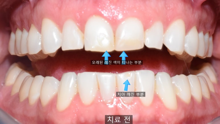 앞니 레진이 오래되어서 변색된 레진 교체 케이스 서울 시청 치과 관련 이미지 2