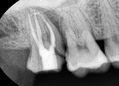 광화문 연세 예감 치과 해외에서도 찾아오는 지르코니아크라운 치료 안내해드려요 관련 이미지 12