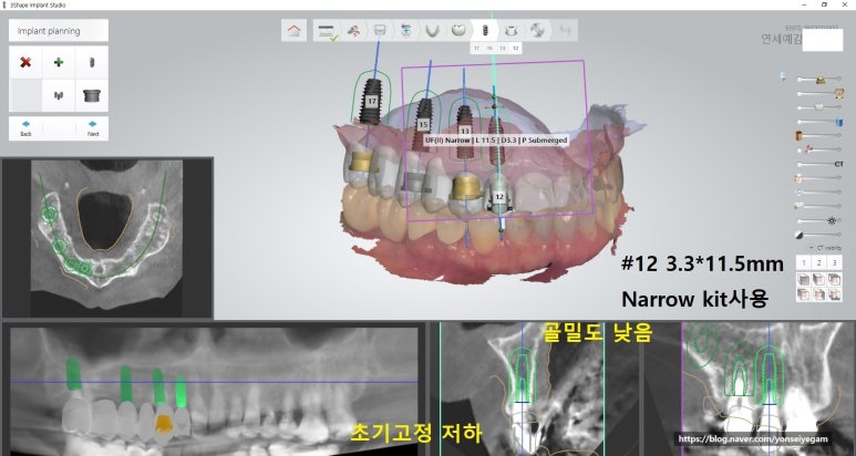 [시청역/서울역]네비게이션인플란트를 이용한 여러개 임플란트 과정 관련 이미지 2