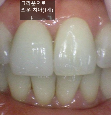 서대문역 지르코니아 크라운, 연세예감치과에서 알려드려요[실제환자사례] 관련 이미지 4