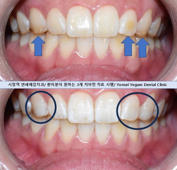 [서울 광화문/남대문] 화이트스팟 레진으로 치료케이스, 비용안내 등등 / 반점치, 반상치 관련 이미지 7