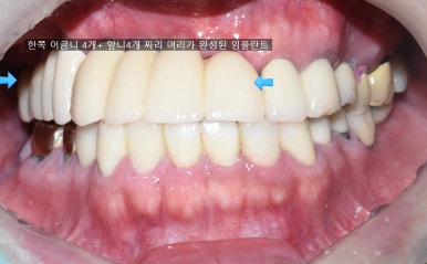 앞니 여러개 임플란트 잘하는 치과 서울역치과 실제사진 관련 이미지 14