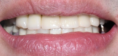 충정로 서울역 근처 고난도 & 재수술 임플란트 수술 치과 관련 이미지 6