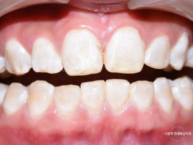 서울시청역 앞니 치아에 갈색 점, 흰색점 치료 전후 관련 이미지 5