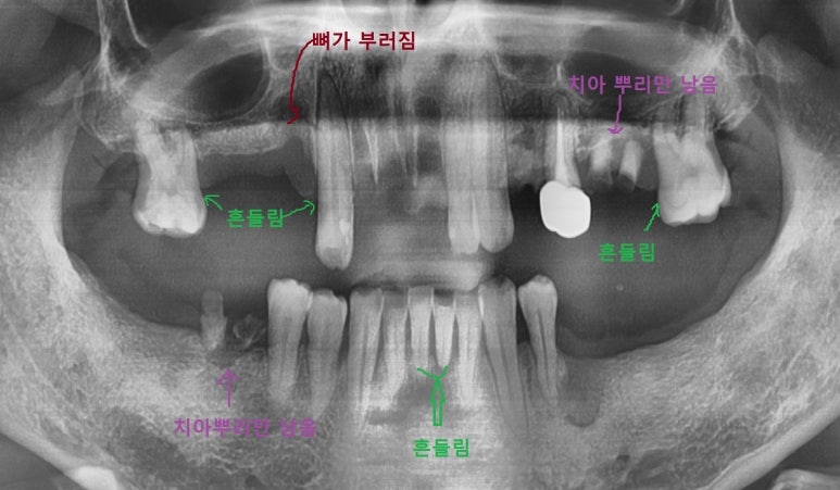 이가 빠졌어요. 이 빠진 환자 보철 환자 케이스 소개 <시청역 연세예감치과> 관련 이미지 2