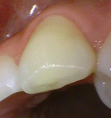 [시청역,서울역/치과] 개개인 맞춤형 치과제작 이갈이 장치로 이를 보호하세요& 비용,가격 정보 관련 이미지 1