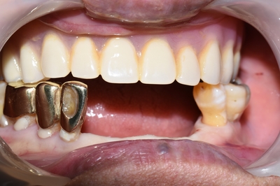 [종로/시청역]실제 환자의 보험 임플란트, 보험 틀니 사례 소개합니다. 젊어지는틀니,임플란트 치료 관련 이미지 8