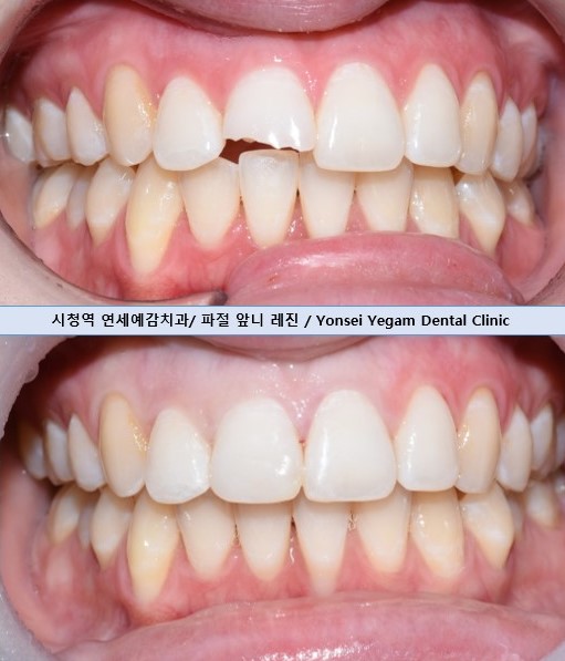 [광화문/연세예감치과] 앞니 치아가 파절되었다면? 앞니 부러짐.레진/크라운/임플란트 관련 이미지 8