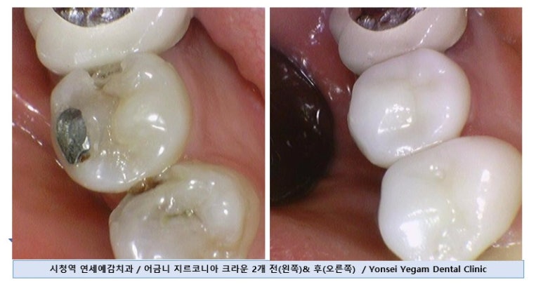 [서대문/광화문]외국인도 찾아오는 치아색나는 크라운, 지르코니아 크라운 치료 치과 어떻게 변하는지 확인해보아요 관련 이미지 1