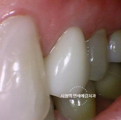[시청역치과] 미국에서도 크라운 하러 일부러 찾아오는 치과 인증사진 관련 이미지 2