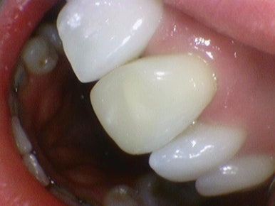 시청역 치과/ 신경이 죽은 치아의 변색 치료 위한 크라운 케이스&가격도 / 외국인 환자분이 눈물을 흘리셨어요 관련 이미지 1