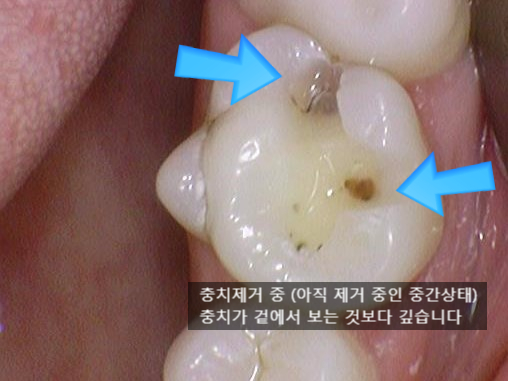 [충정로/치과] 인레이해야한다고 진단받으셨나요? 이맥스(세라믹)인레이 실제케이스 같이 살펴보아요 관련 이미지 3