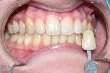 치아미백, 치과에서 하면 얼마나 오래갈까? 궁금하시다면, 실제사례 바탕으로 알아보아요 지속,유지 관련 이미지 5