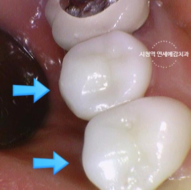 시청역 충정로 충치치료 치과 추천 관련 이미지 10