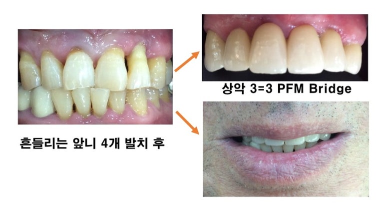 서울시청역 남대문 임플란트 대신에 앞니 브릿지를 한 케이스 관련 이미지 17